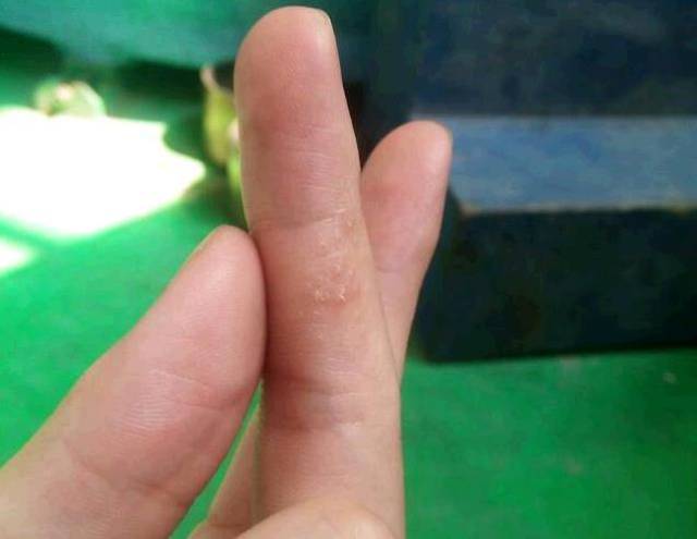 特别提醒:手上经常起小水泡痒,身体会被你"伤透"