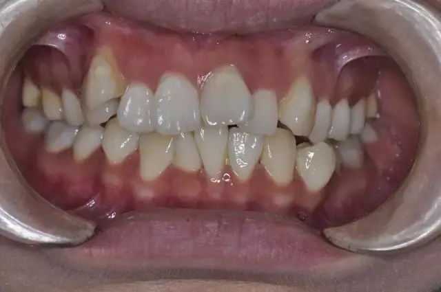 【牙齿正畸】人人都在怕的黑三角,要怎么绕过这道坎?