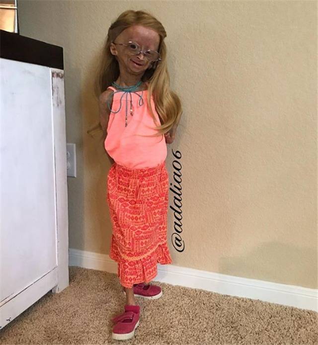 早衰症女孩头发掉光形如et外星人乐观不屈收获150万粉丝