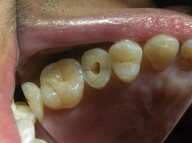 牙裂的五大分类