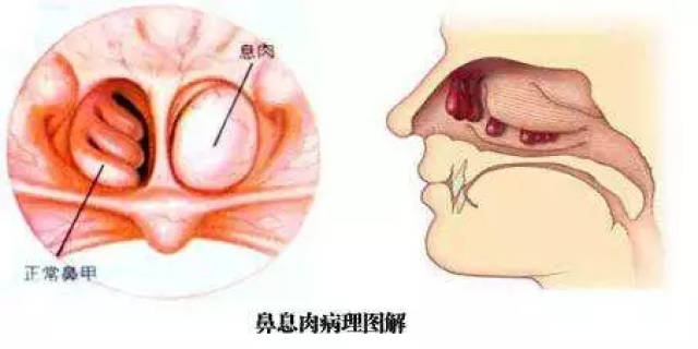 7,息肉阻塞鼻窦引流,可引起鼻窦炎,患者出现鼻背,额部及面颊部胀痛不