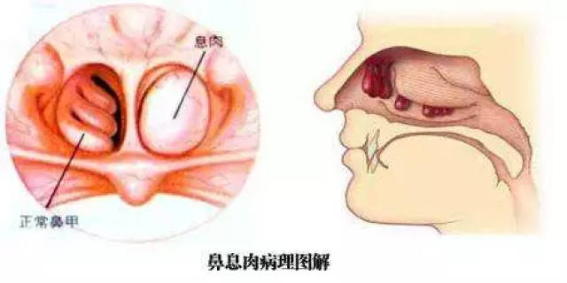 鼻息肉的危害,不仅仅是鼻子堵塞那么简单!