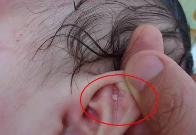 耳朵外面的,当反复湿疹的时候,就容易并发细菌感染,容易引发外耳道炎