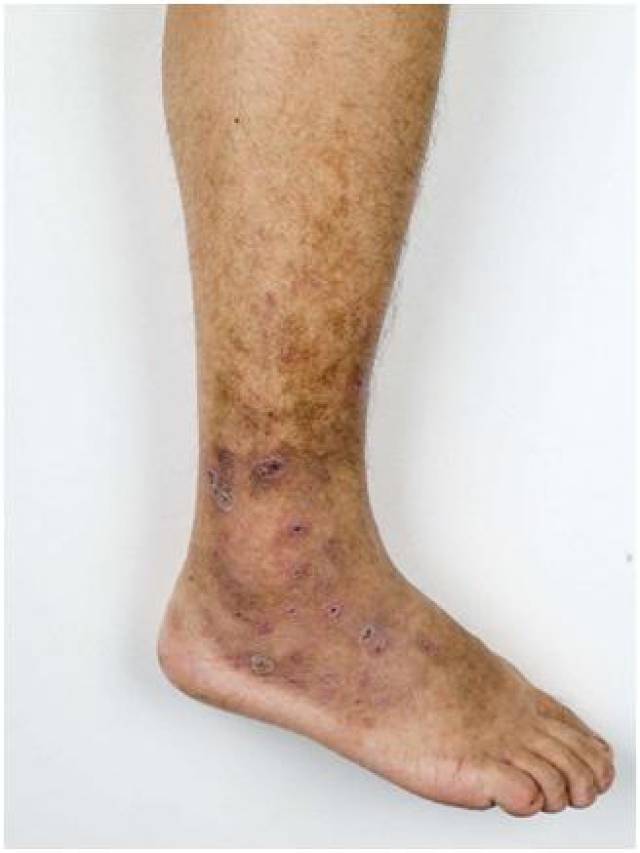 【下肢静脉曲张并发症继发感染】