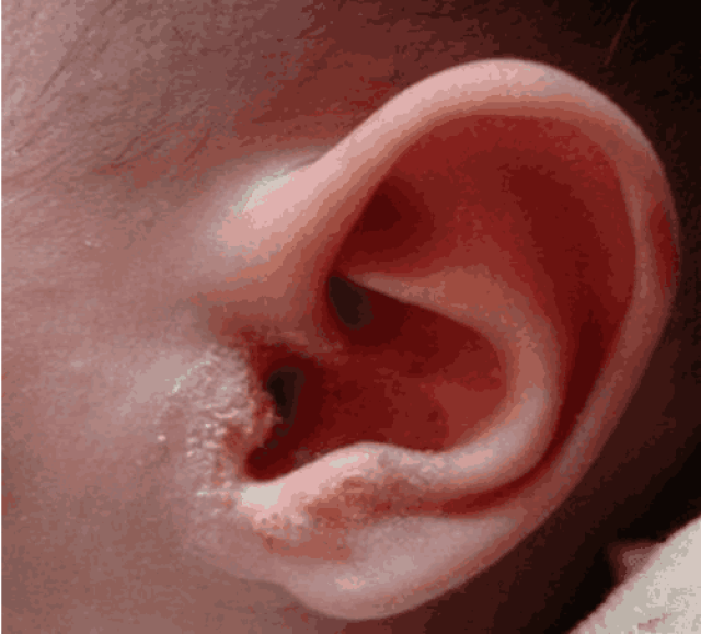 7个月大的宝宝得了"中耳炎", 只因妈妈爱美惹了祸!