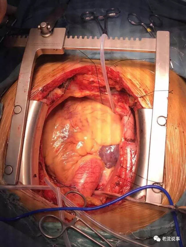 心脏移植手术图解图片