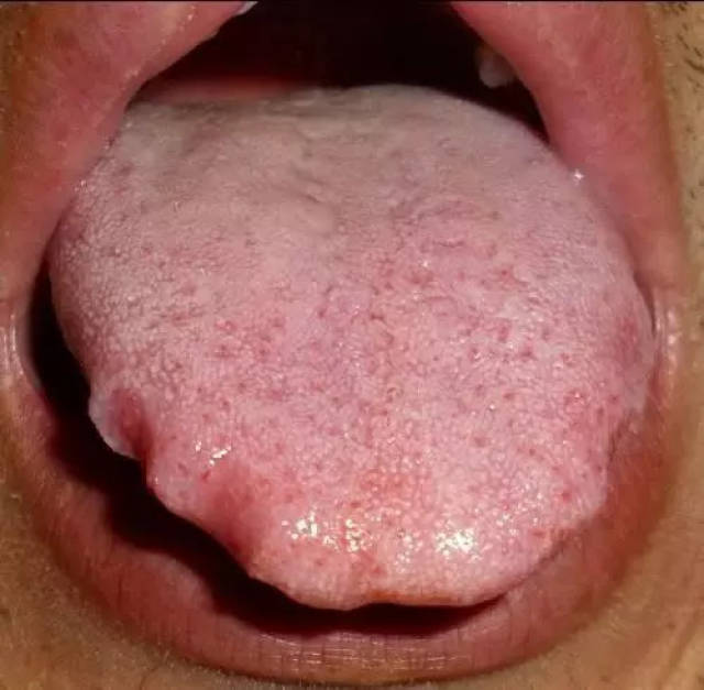 吸毒的人的舌头图片图片