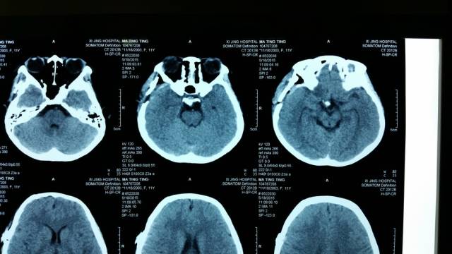 术中情况:彻底分离侧裂,显露视交叉后缘,切开终板,显露肿瘤.