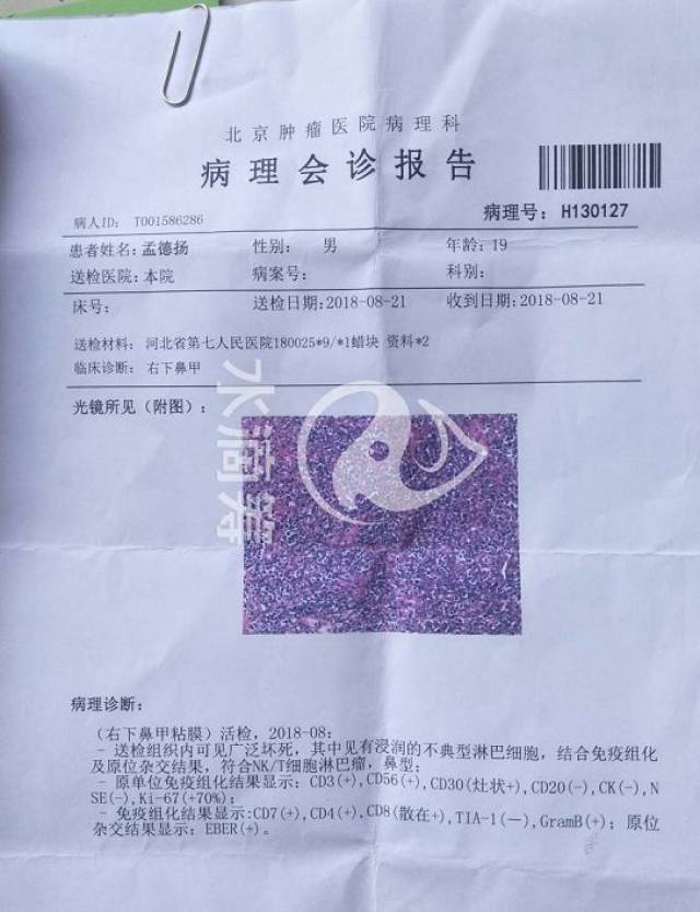 定州19岁少年竟患恶性淋巴瘤.