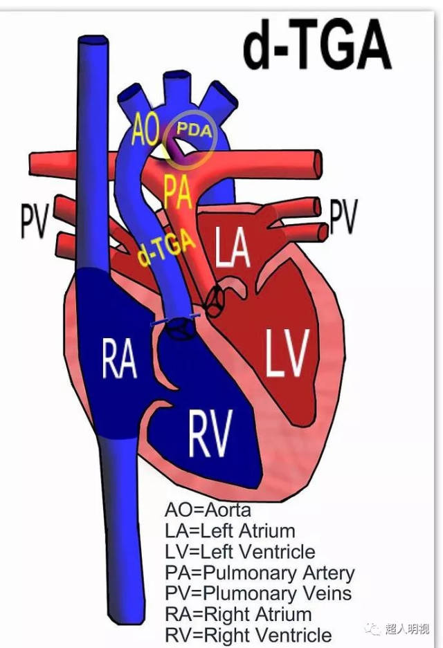 大动脉转位解剖图图片