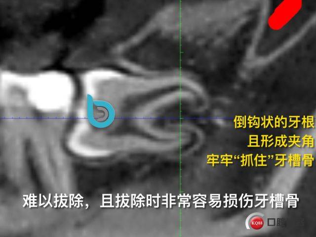 倒钩状牙根的 微创拔除
