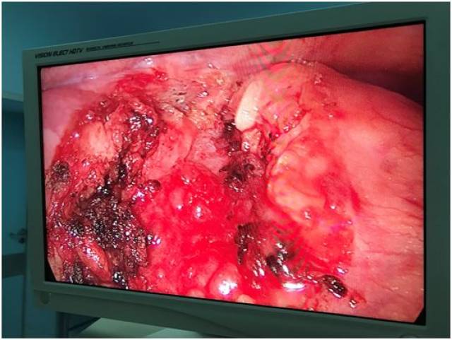 再接再厉!我院又一例单孔胸腔镜下胸腺瘤切除术顺利完成