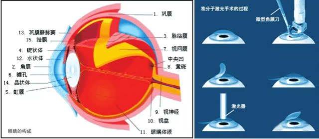 激光能给你一双明目吗？准分子激光手术还是有相当危险性的_手机搜狐网