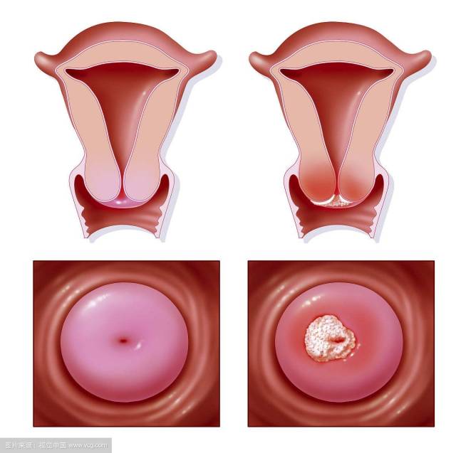 子宫下垂宫颈口图片图片
