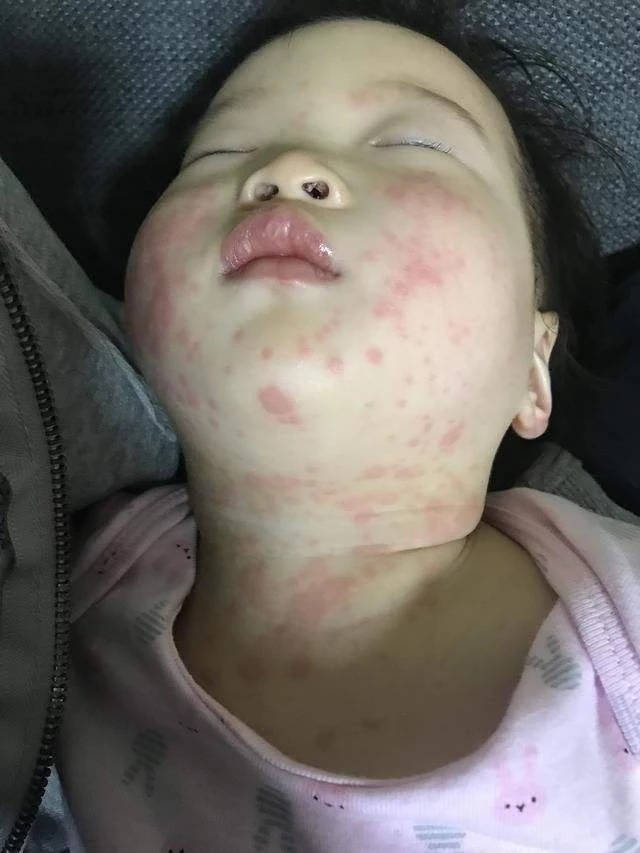 儿童感染hpv丘疹图片图片