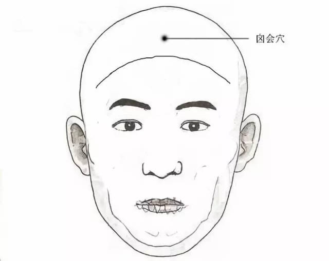 北京中医药大学东直门医院 刘颖自灸囟会穴治头痛