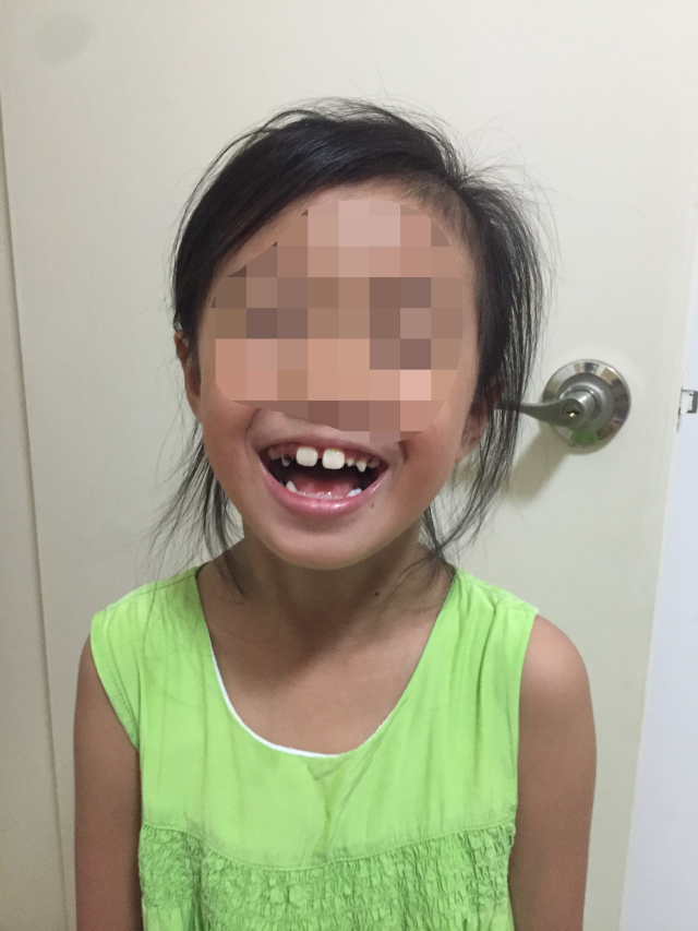 深圳3岁女童喝夜奶不刷牙,补一口烂牙花了3万多