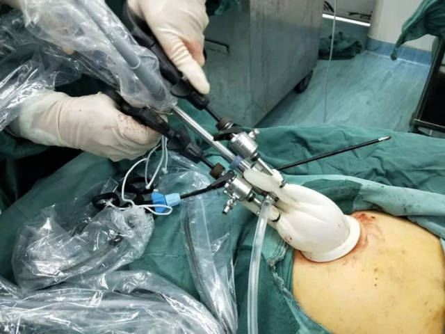 我院开展全市首例单孔腹腔镜手术,微创精细化又向前迈出一大步