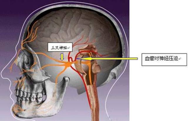 臉上陣陣刀割樣的痛你能忍多久?專家:面部持續疼痛警惕三叉神經病變