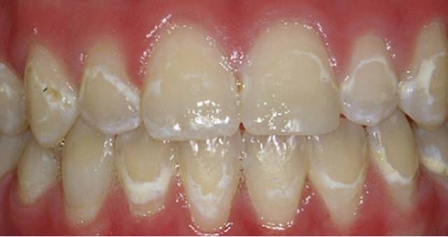 牙齿发白钙化图片图片
