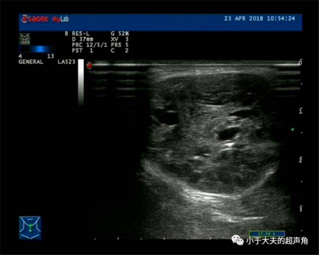 一份思路清晰の病例讨论2 - Ectopic Thyroid（ET）_手机搜狐网