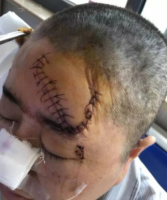 芜湖一女子街头劝架被砍伤,缝了106针,事后称今后遇到这种事还会管 !