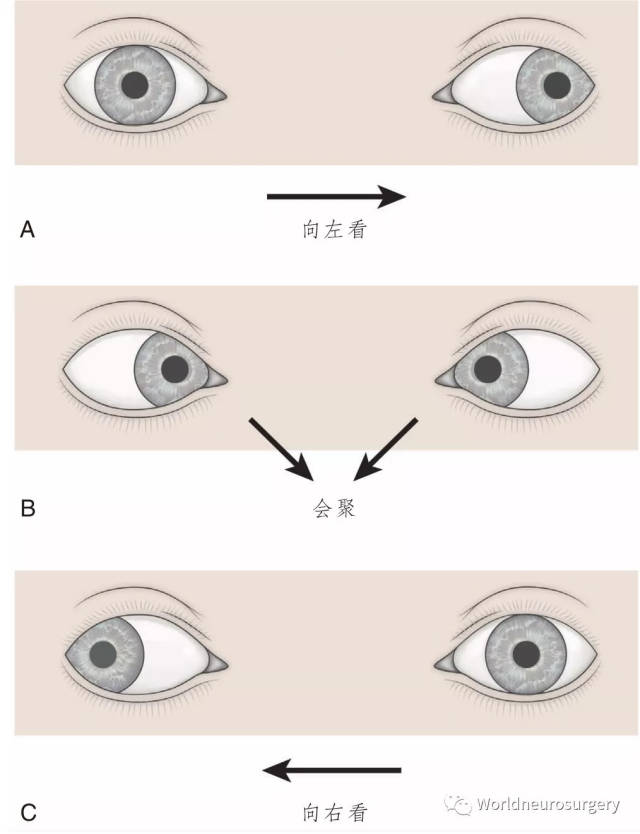 核性眼肌麻痹图片