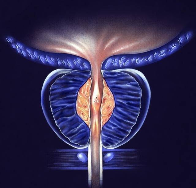 男性的前列腺钙化是什么?会不会影响生理功能