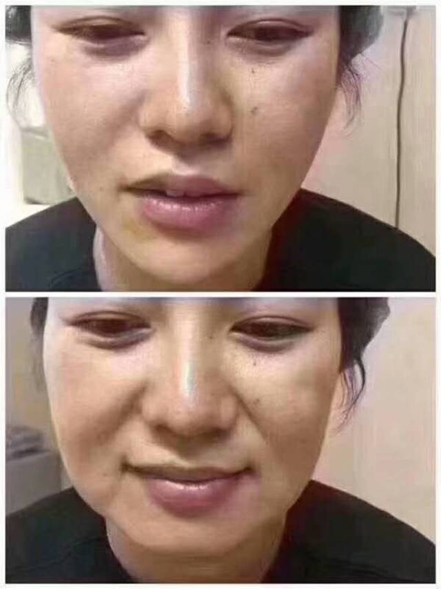 皮肤的 松弛,下垂,肥大