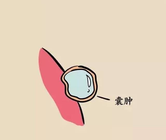 【健康科普】体检查出囊肿,结节,息肉,增生是不是癌症先兆?