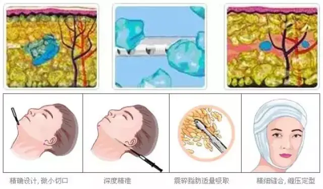 科普贴 | 光纤溶脂瘦脸,紧致有型又嫩滑