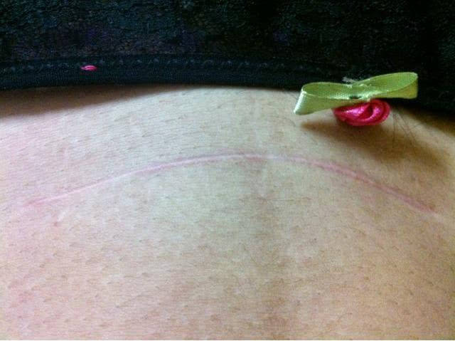 剖腹产后疤痕正常图片图片