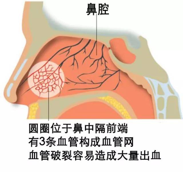 鼻出血控制不住,别怕,介入栓塞止血新方法