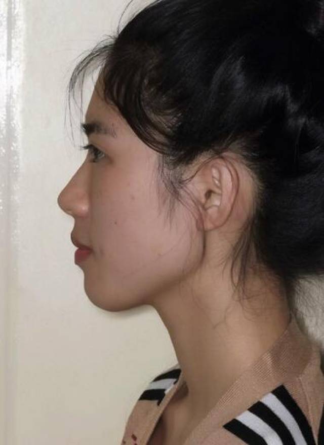 小王是属于下颌角特突出的那种,正面看过去要是下巴再短点就是标准的