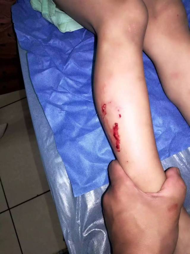 被狗咬13天后 ,阜阳6岁男童狂犬病发离世!商报记者深度还原事件始末