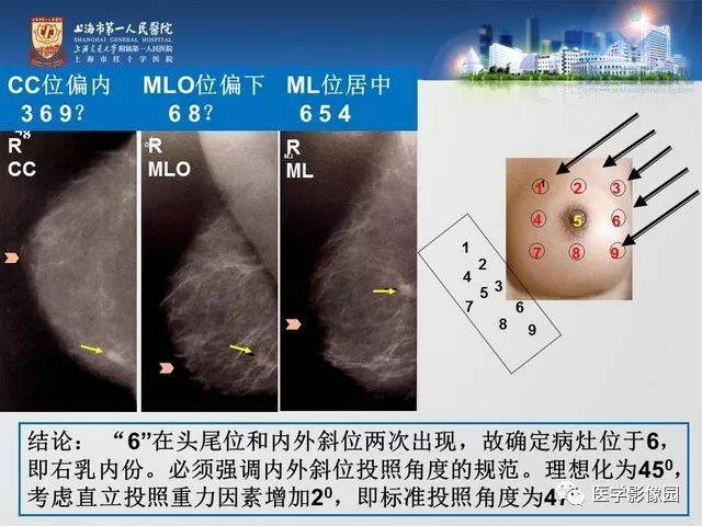 專家手把手教您x線攝影如何對乳腺病灶精確定位 | 影像天地