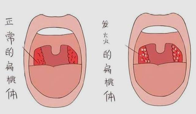 扁桃体的位置图片图片