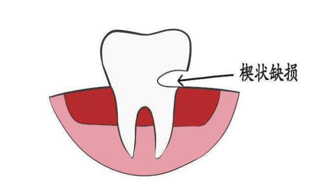 牙齒得了楔狀缺損該如何治療?