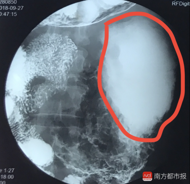 他的小肠上吹出了个巨大气球,还爆了, 连忙从非洲飞回国救治_手机搜狐