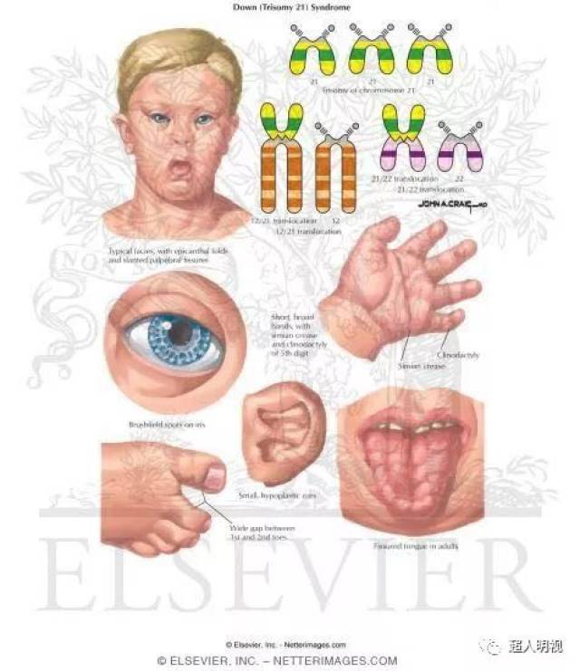 唐氏综合征大排畸时也要警惕