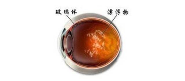 眼睛液化玻璃体混浊怎么办?中老年尤其高度近视患者特别注意
