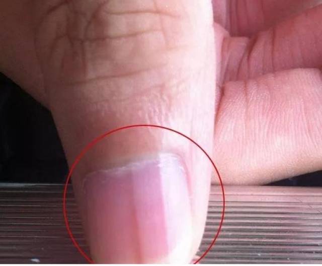 其实,指甲上的竖纹被医学上称为"甲纵沟",对于大多数人而言,其实都是