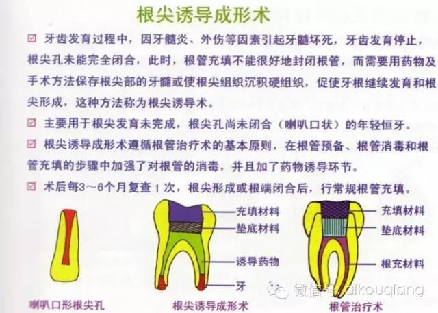 根尖诱导成形术步骤图片