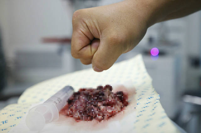 巨大颅内肿瘤患者术后恢复良好平安出院