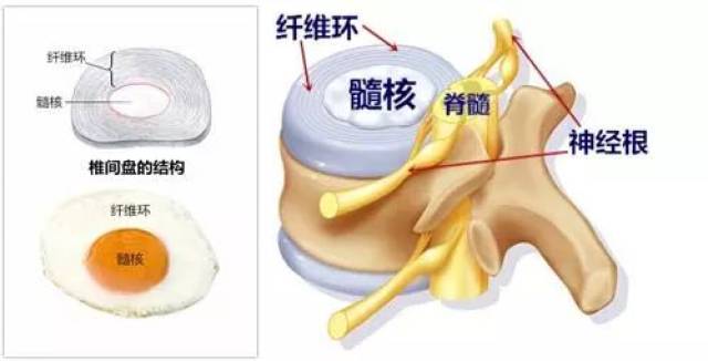 腰椎间盘突出症最常见的10个误区