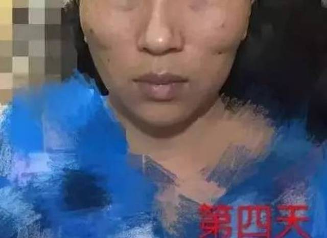 她做线雕失败后,患上抑郁症差点自杀!