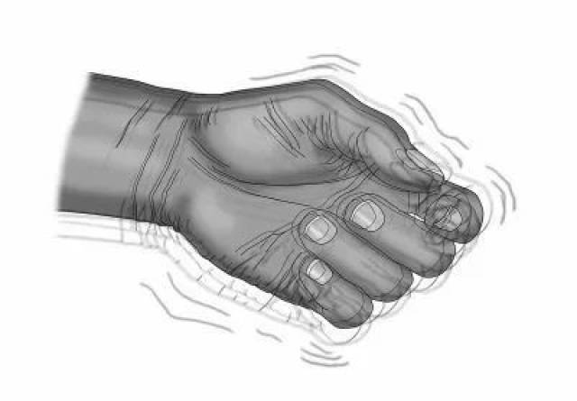 肢体颤抖就是得了帕金森?点进来自己诊断一下