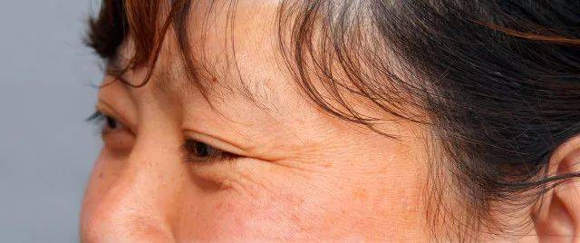 眼角的皱纹让三十岁的刘阿姨看起来有四十岁