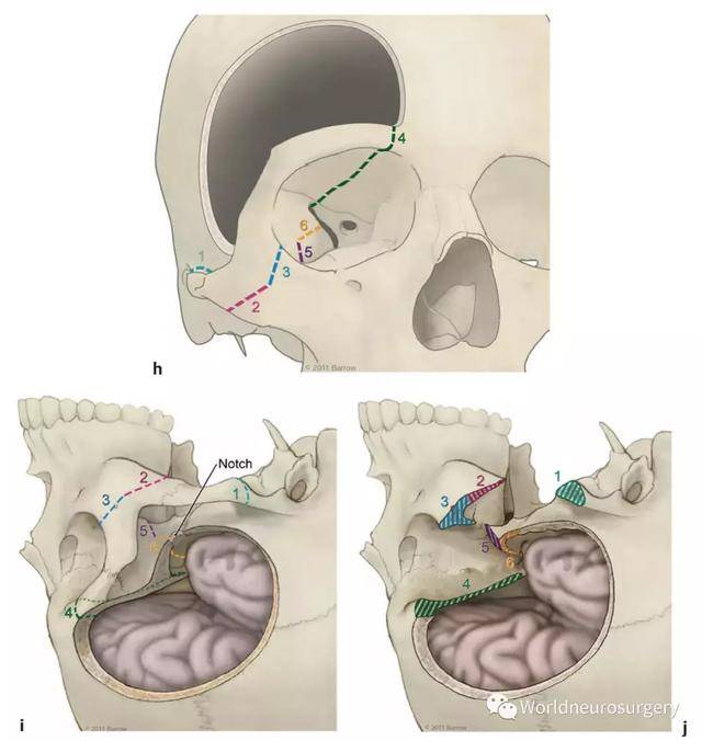 翼点入路|spetzler教授脑干手术入路