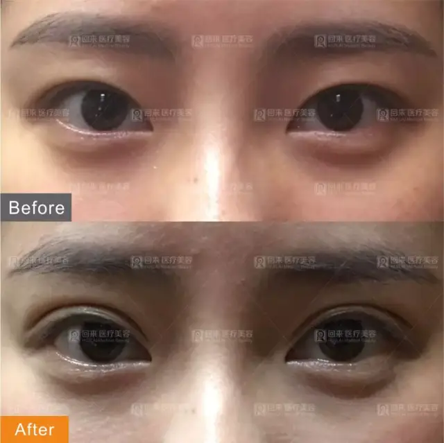 "亚洲眼王"——徐在敦来啦!纯韩技艺,为您打造完美综合媚眼!